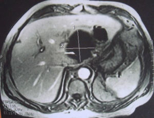 Imagem de ressonância magnética abdominal em corte transversal. Salienta-se a presença de 2 grandes cavidades de abcesso hepático, sem líquido, ambas localizadas no lobo esquerdo do fígado. A maior está mais próxima do hilo hepático.