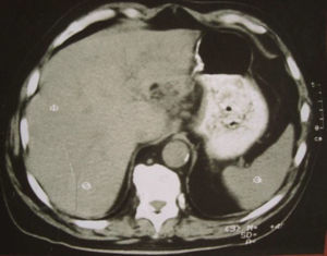 Imagem de tomografia axial computorizada abdominal feita cerca de um mês após a alta do paciente com abcesso hepático piogénico. Observa-se uma pequena cavidade hepática perihilar. Trata-se de um remanescente do abcesso em fase de resolução.