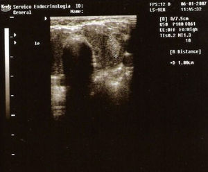 Nodule with 1cm in the left lobe of thyroid.