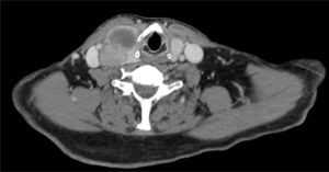 Neck CT scan revealed enlargement of thyroid right lobe by three expansive solid lesions.