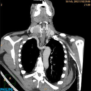 Neck CT scan: right subclavian artery is positioned near the left subclavian artery and crosses the mediastinum with retroesophageal path – arteria lusoria.