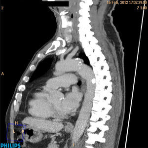 Neck CT scan. Origin of arteria lusoria (arrow).
