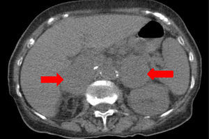 TC abdominal – aumento bilateral das glândulas suprarrenais.