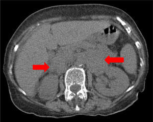 TC abdominal – aumento bilateral das glândulas suprarrenais.