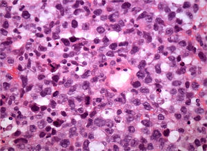 Histologia coloração hematoxilina‐eosina linfócitos atípicos.