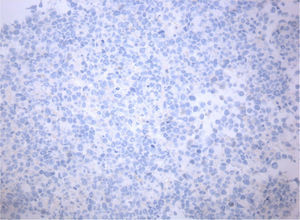 Imuno‐histoquímica – AE1/AE3 e cromogranina A negativas (excluído carcinoma da suprarrenal).