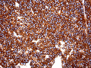 Imuno‐histoquímica – CD45 positivo.