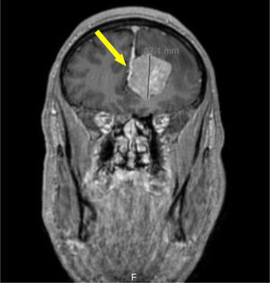 Meningioma (seta). RMN cerebral, perfil coronal, ponderação T1, com gadolínio.