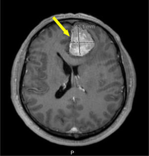 Meningioma (seta). RMN cerebral, perfil transversal, ponderação T1, com gadolínio.