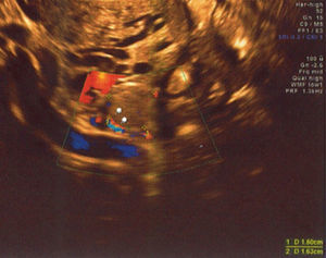 Tumor do ovário esquerdo diagnosticado por ecografia endovaginal.