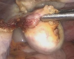 Imagem intra‐operatória do ovário esquerdo com tumor de Leydig.