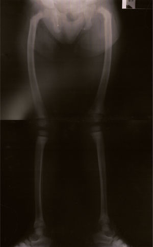 Radiografia dos membros inferiores, efetuada antes do início do tratamento com paricalcitol, revelando deformidades ósseas semelhantes às observadas no raquitismo: arqueamento dos fémures e joelhos valgos.