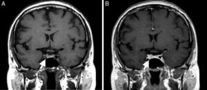 Imagens de ressonância magnética nuclear selar em plano coronal T1 sem (A) e com gadolínio (B). Identifica‐se microadenoma na hemi‐hipófise direita (seta), com elevação do bordo hipofisário, sem alteração do sinal antes e após contraste.