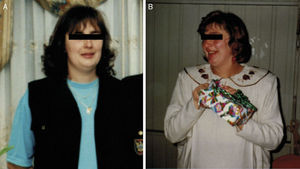 Fotografias da doente durante o seguimento. A) Ausência de clínica associada à síndrome de Cushing, correspondendo a um período de secreção normal de cortisol (julho/2002). B) Presença de algumas das características da síndrome, nomeadamente aumento ponderal, pletora facial e face em lua‐cheia, em fase de hipercortisolismo laboratorial (maio/2003).