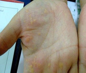 Panel A: skin lesions on the patient's hand (xanthomas palmaris).