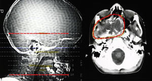 TAC de planeamento da radioterapia 2D onde se observa o envolvimento da região selar no campo irradiado.