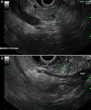Linear endoscopic ultrasound: (a) 6mm pancreatic head cyst; (b) normal uncinate process (UNC) underlined by the superior mesenteric vein (SMV) as seen through D2.