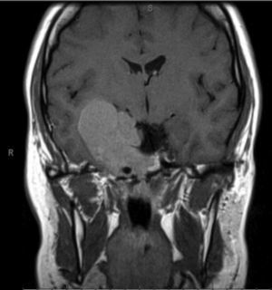 RMN T1 corte coronal. Volumosa lesão centrada na região parasselar direita com invasão do seio cavernoso.