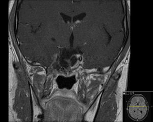 Involução das dimensões lesionais face à figura 1.