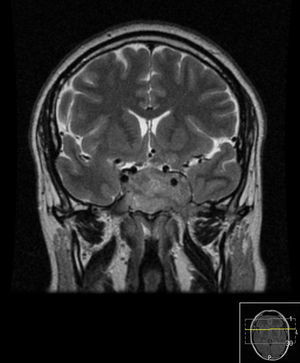 RMN T2 corte coronal. Lesão expansiva extra‐axial, com ponto de partida selar, mais evidente à esquerda.