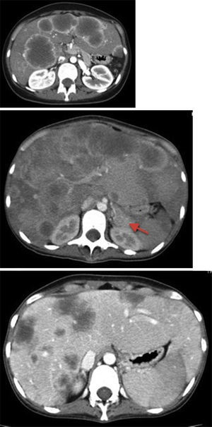 Imagens de TC toracoabdominopélvico com contraste endovenoso, mostrando metastização hepática exuberante – nódulos espontaneamente hipodensos, de diâmetro variável até 75mm, com anel de hipercaptação periférico sugestivo de necrose central. A seta aponta para o tumor primário a nível da cauda do pâncreas. A última imagem mostra a regressão das lesões em fase pós‐quimioterapia.