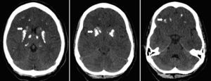 CT scan showing bilateral, symmetric calcifications in thalamus, basal ganglia and white subcortical frontotemporal substance (arrows).