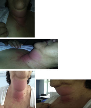 Sinais inflamatórios da região cervical. Identificam‐se exuberantes sinais inflamatórios da região cervical, com edema calor e rubor que se estendia em toda a região submentoniana até à articulação esterno‐clavicular.