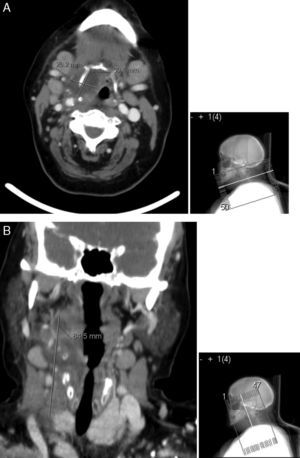 TC cervical. A: o abcesso envolve a metade direita do osso hioide, com um diâmetro máximo a este nível de 30mm e com ligeira compressão da via aérea superior. B: observa‐se uma extensão longitudinal de 85mm.