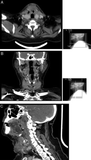 TC cervical do segundo internamento. Observa‐se um diâmetro transverso máximo de 42,5mm (A), com uma extensão máxima de cerca de 120mm até ao plano das clavículas (B). Em C são evidentes as alterações características de celulite cutânea a nível da região cervical.