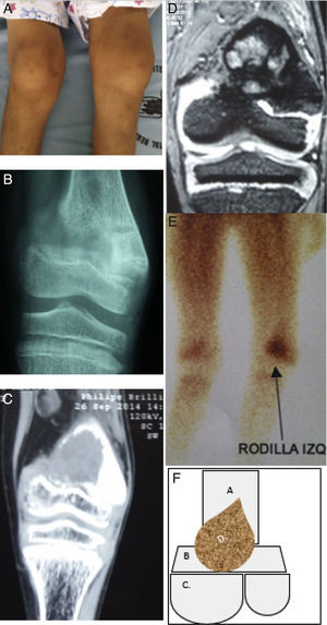 Descripción de la lesión ósea de tumor pardo en el paciente. 1A: En el examen físico se evidenció genu‐valgus marcado en miembro inferior izquierdo, con limitación funcional y edema leve. 1B: Radiografía anteroposterior de rodilla izquierda, donde se denota fractura incompleta en metáfisis de fémur izquierdo. 1C: TC en misma zona anatómica donde se evidencia disminución de densidad ósea a nivel de metáfisis femoral y lesión con apariencia de masa infiltrante. 1D: Resonancia magnética nuclear en misma zona anatómica donde se denota masa infiltrante que se localiza en metáfisis femoral y no compromete otras estructuras. 1E: Estudio de gammagrafía ósea donde se muestra captación de radiofármaco en metáfisis distal de fémur izquierdo. 1F: Esquema donde se describe como: A. Epífisis distal de fémur, B. Metáfisis femoral y cartílago fisiario, C. Superficies articulares distales de fémur y D. Tumor pardo localizado en metáfisis distal que respeta componente articular del fémur y tejidos blandos y sin embargo compromete cartílago fisiario. (Elaborado por: Juan Miguel Alemán I. Tomado de: Centro de imágenes del Hospital José Carrasco Arteaga).