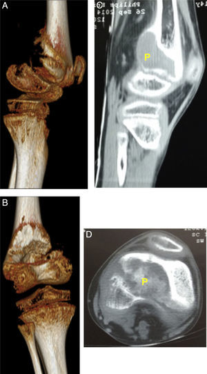 Descripción de la lesión ósea de tumor pardo en el paciente. 2A: Visión tomográfica en 3 dimensiones, vista lateral de epífisis distal de fémur izquierda. 2B: TC de fémur izquierdo vista sagital, se identifica como P, tumor pardo. 2C: Visión tomográfica en 3 dimensiones, vista posterior de epífisis distal de fémur izquierda. 2D: TC de fémur izquierdo vista coronal, se identifica como P al tumor pardo.