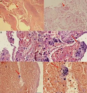 Hallazgos histológicos de la muestra tomada durante la biopsia. 3A: Muestra histológica procesada donde se evidencia célula gigante multinucleada. 3B: Muestra histológica procesada que denota gran cantidad de células multinucleadas. 3C: Identificación precisa de la célula gigante multinucleada, característica del tumor pardo óseo. (Elaborado por autores. Tomado de: Centro de Patología del Hospital José Carrasco Arteaga).