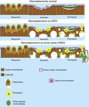 Esquema del remodelamiento óseo en la osteítis fibrosa quística (OFQ) y en la formación del tumor pardo. Se puede apreciar que durante el remodelamiento óseo en OFQ existe gran actividad osteoclástica dando aspecto quístico del hueso, la pérdida mineral ósea trae consigo la activación de los fibroblastos que crean fibrosis en los lugares de pérdida ósea. En cambio en la formación de tumor pardo se añade la presencia de células multinucleadas gigantes y los fibroblastos que crean la apariencia de un seudotumor óseo. (Elaborado por: Juan Miguel Alemán I. Tomado de: Rosenberg et al.4).