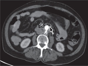 Angio-TC demonstrando bolhas de gás peri-enxerto protésico, na região do lúmen duodenal.