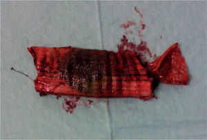 Porção de segmento de prótese bifurcada de Dacron® removido, onde se observa a coloração castanha biliar de protese que se encontrava endoduodenal.