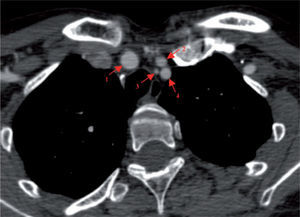 Quatro ramos do arco aórtico: 1: tronco braquicefálico; 2: artéria carótida comum esquerda; 3: artéria vertebral esquerda; 4: artéria subclávia esquerda.