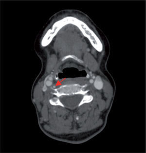 Artéria vertebral direita anteriormente à apófise transversa de C4 (seta).