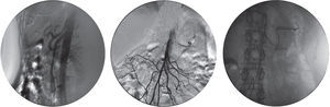 Arteriografia da aorta abdominal, seletiva da artéria mesentérica superior e seletiva da artéria esplénica.