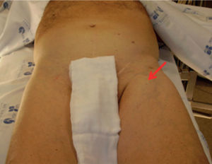 Left femoral pulsatile and expansible mass (red arrow).