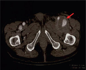 Computed tomography scan showing bilateral profunda femoris artery aneurysm, including a 6cm diameter aneurysm on the left side (red arrow).
