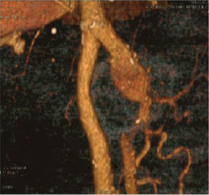 Three-dimensional computed tomography scan reconstruction showing the 6cm diameter left bilateral profunda femoris artery aneurysm.