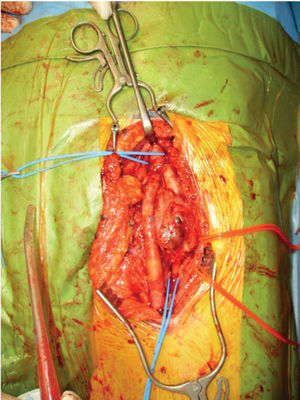 Left bilateral profunda femoris artery aneurysm exposed through a longitudinal groin incision. Inflow and outflow vessels are encircled with blue tape and the femoral nerve with red tape.