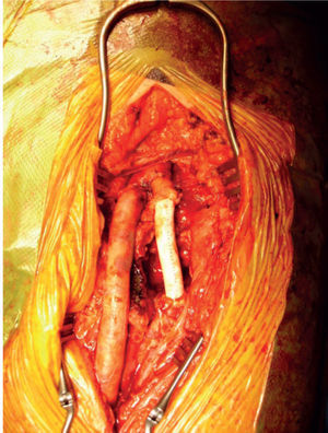 Open aneurysmectomy and polytetrafl uoroethylene (PTFE) graft interposition.