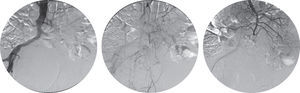 Arteriografia aorto-visceral e seletiva da artéria mesentérica superior.