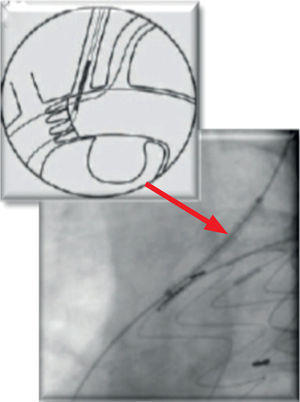 Observa-se oclusão da ACCE pós-colocação de endoprótese aórtica. A seta vermelha demonstra a libertação de stent auto-expansivel para repermeabilização desta artéria.