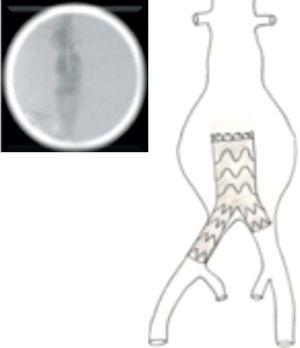 Libertação da endoprótese bifurcada recuando-a até à bifurcação aórtica.