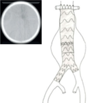 Libertação de endoprótese torácica como cuff proximal.