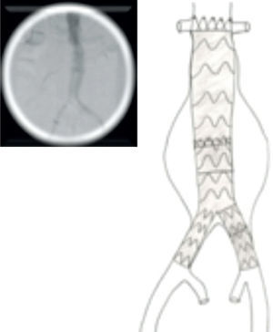 Extensão do ramo contra-lateral e angiografia final com exclusão do aneurisma.