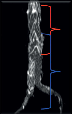 Chaveta vermelha identifica a endoprótese torácica utilizada com cuff proximal e chaveta azul corresponde à endoprótese abdominal bifurcada.