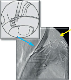 Observa-se a recanalização endovascular da ACCE (seta azul) e embolização eficaz da ASE (seta amarela).
